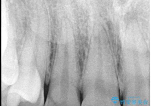 【セラミッククラウン】【精密根管治療】前歯が痛いの治療前