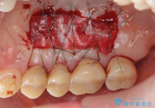 遊離歯肉移植術を伴うインプラント治療の治療中