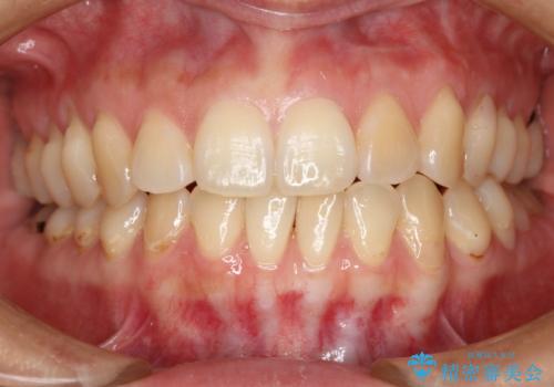 下の前歯のガタつきを治したい インビザライン・ライトパッケージの治療前