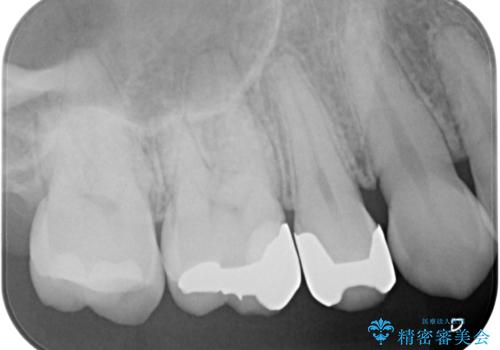 銀歯をやり替えたい セラミックインレー修復の治療前