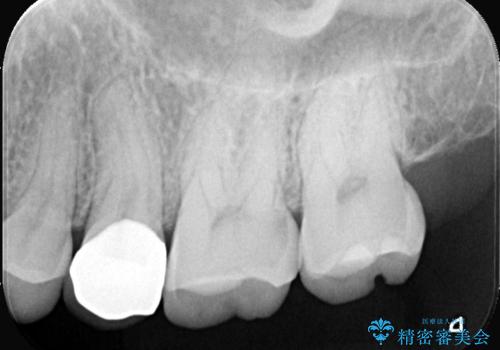銀歯をやり替えたい 〈セラミッククラウン〉の治療後