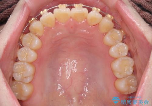 前歯のねじれ 矯正治療による歯並び改善の治療前