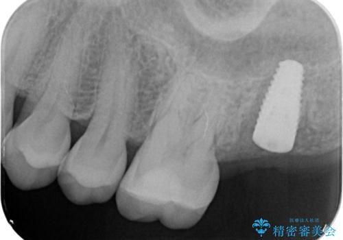 噛むと歯が疼く 歯牙破折からのインプラント治療の治療中