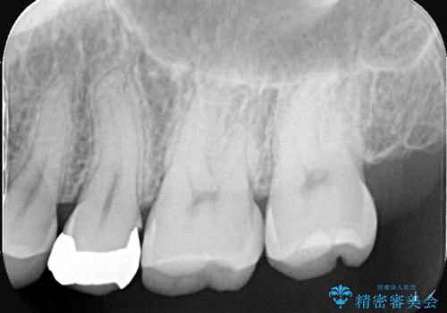 銀歯をやり替えたい 〈セラミッククラウン〉の治療前