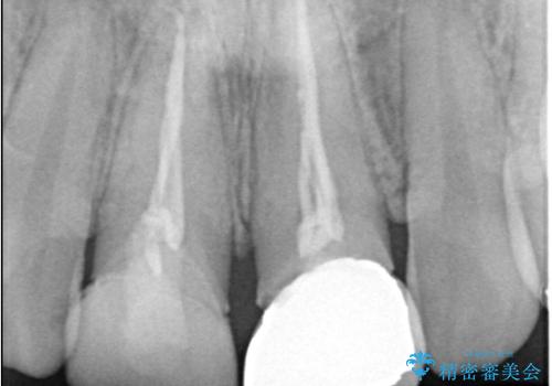 前歯の見た目と根の悩みを根本から解決の治療前