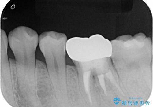 左下奥歯が腫れて痛い フルジルコニアクラウンの治療後