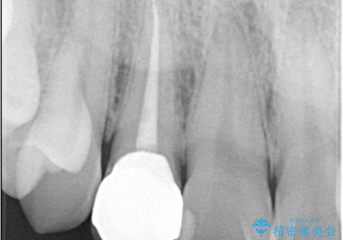 【セラミッククラウン】【精密根管治療】前歯が痛いの治療後