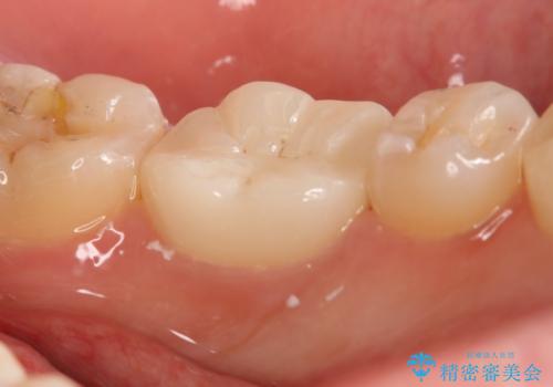 左下奥歯が腫れて痛い　フルジルコニアクラウンの治療後