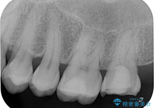 噛むと歯が疼く 歯牙破折からのインプラント治療の治療前