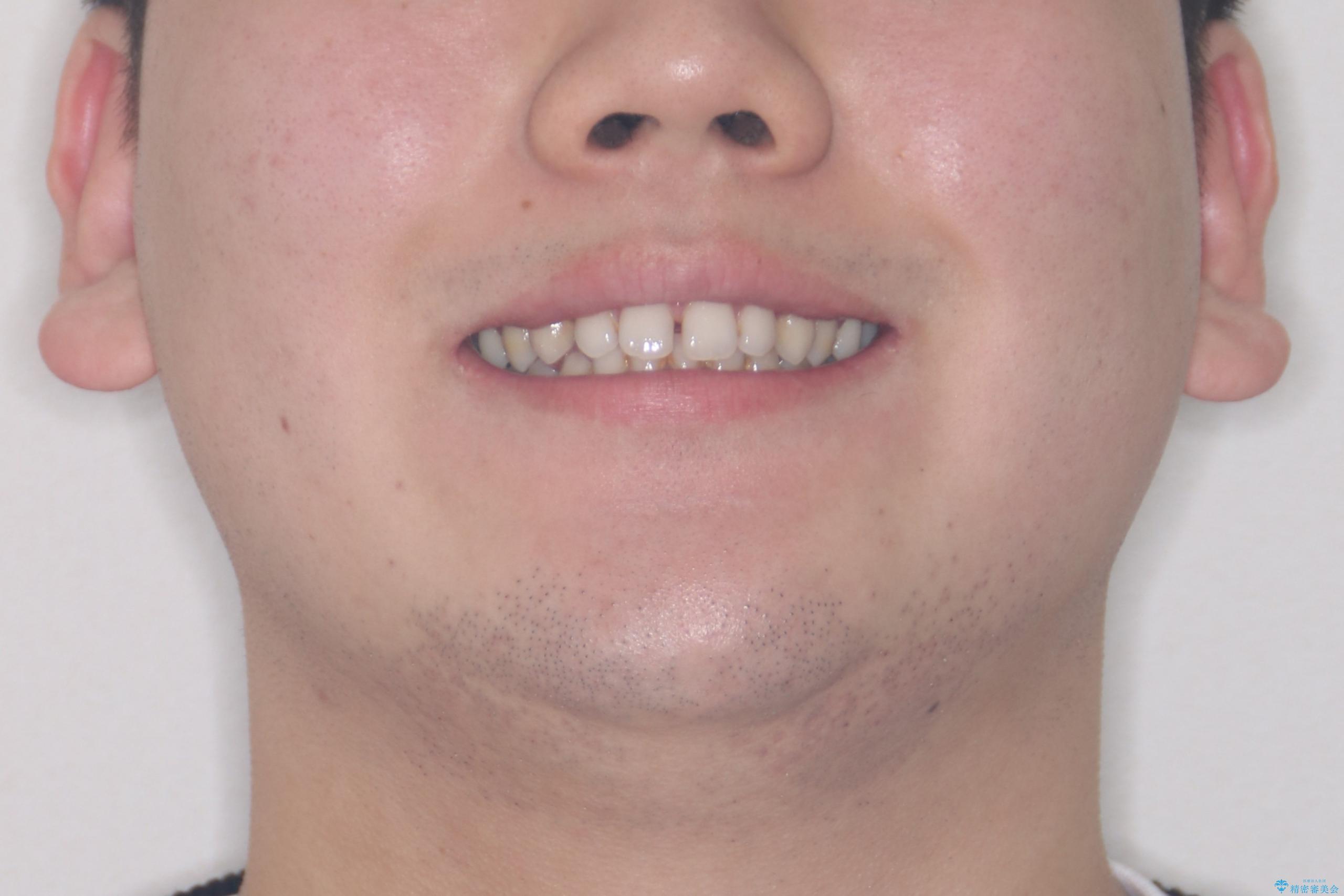 【ワイヤー矯正】歯列の隙間を閉じたいの治療前(顔貌)