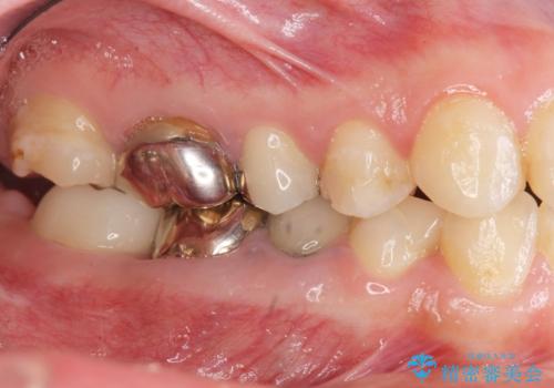 遊離歯肉移植術を伴うインプラント治療の治療前