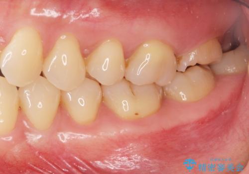 噛むと歯が疼く 歯牙破折からのインプラント治療の症例 治療前