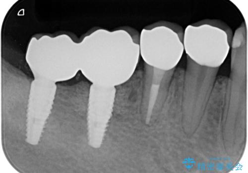 遊離歯肉移植術を伴うインプラント治療の治療後