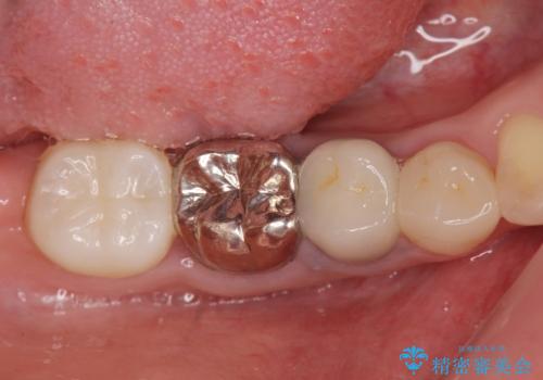 遊離歯肉移植術を伴うインプラント治療の治療前