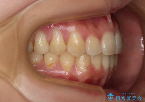 下の前歯のガタつきを治したい インビザライン・ライトパッケージの治療後