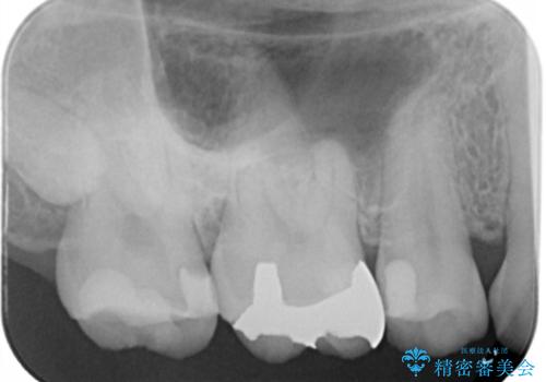 奥歯の再治療をしたい　ゴールドインレーの治療前