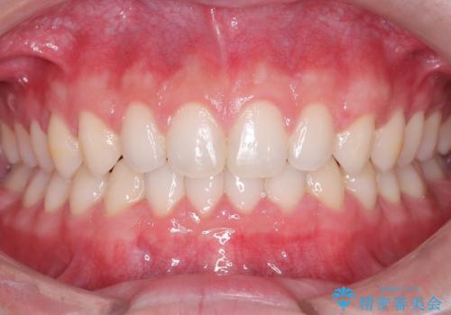 【ワイヤー矯正】歯列の隙間を閉じたいの治療後