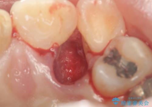 著しいがたつきによる清掃困難 歯牙抜去とセラミック治療の治療前