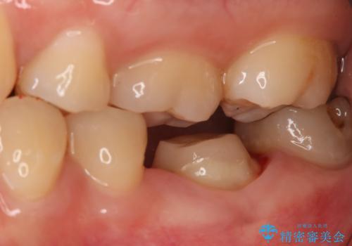 左下奥歯が腫れて痛い フルジルコニアクラウンの治療中