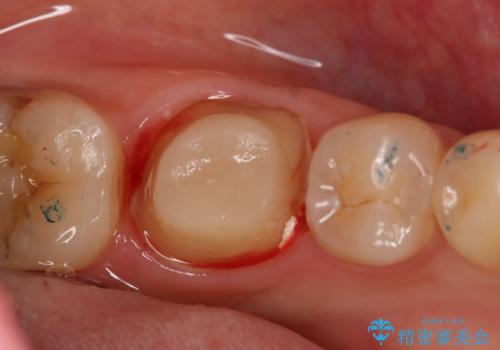 左下奥歯が腫れて痛い　フルジルコニアクラウンの治療中