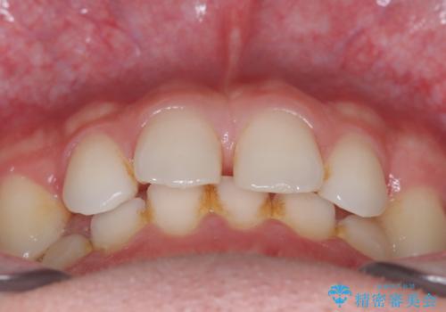 【ワイヤー矯正】歯列の隙間を閉じたいの治療前