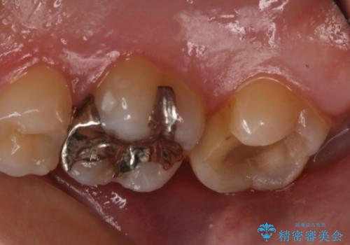 奥歯の再治療をしたい ゴールドインレーの治療中