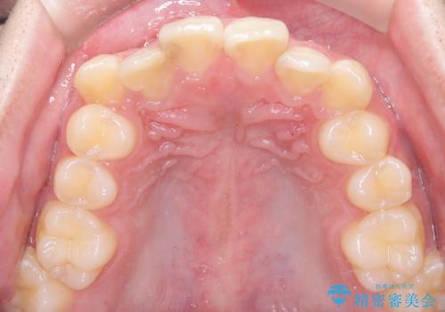 【セラミッククラウン】【精密根管治療】前歯が痛いの治療前