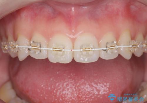 前歯のねじれをきれいに 部分ワイヤー+マウスピース矯正の治療前