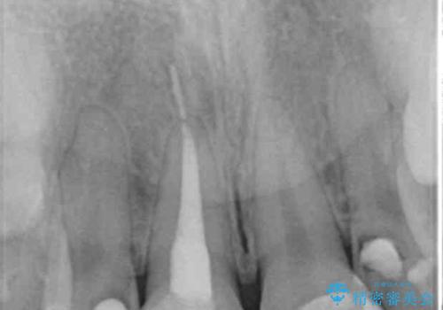 虫歯だらけの前歯をセラミック治療の治療前