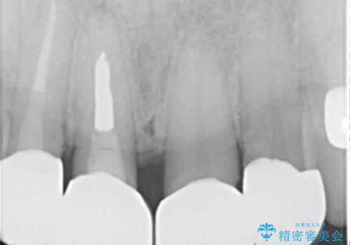 前歯の被せ物をリニューアルの治療後