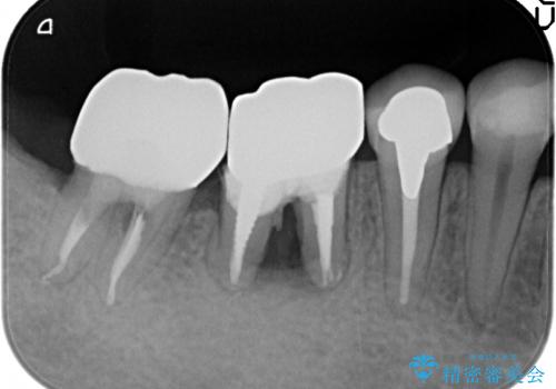 遊離歯肉移植術を伴うインプラント治療の治療前
