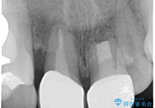 著しいがたつきによる清掃困難  歯牙抜去とセラミック治療の治療後