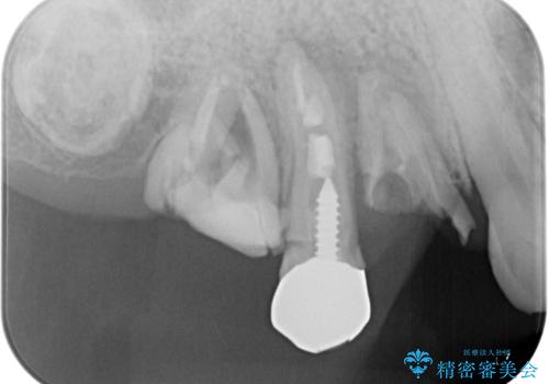 放置した破折歯 即時・早期のインプラント埋入による補綴治療の治療前