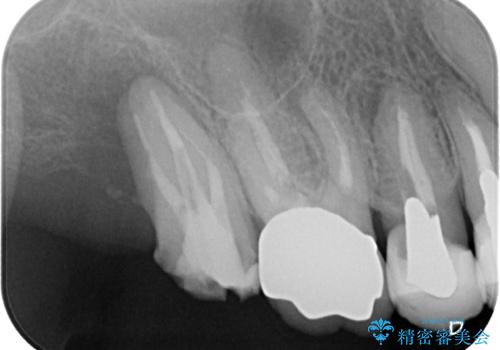 食事が取れないほどの激痛 奥歯のインプラント治療の治療前