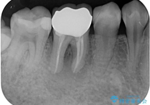 気になる奥歯のむし歯治療の治療前