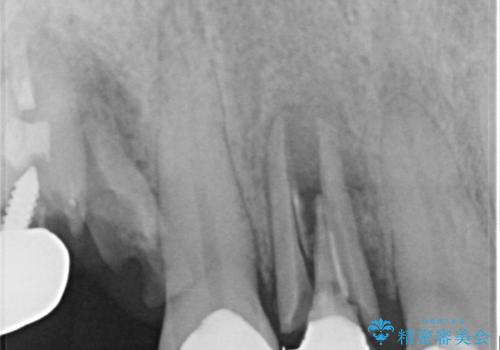 放置した破折歯 即時・早期のインプラント埋入による補綴治療の治療前