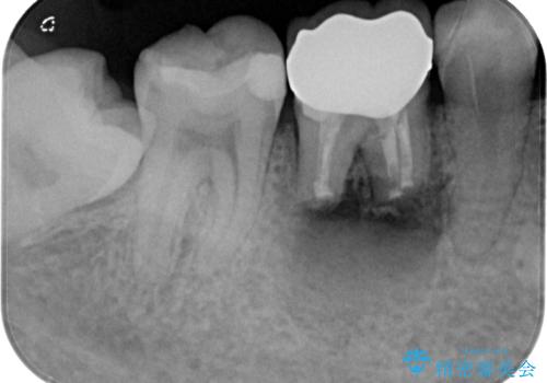 気になる奥歯のむし歯治療の治療中
