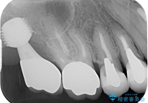 食事が取れないほどの激痛 奥歯のインプラント治療の治療後
