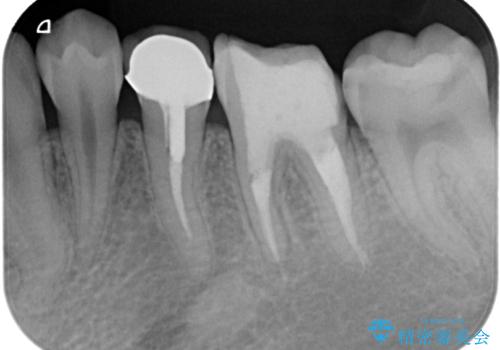 気になる奥歯のむし歯治療の治療前