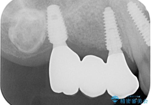 放置した破折歯 即時・早期のインプラント埋入による補綴治療の治療後