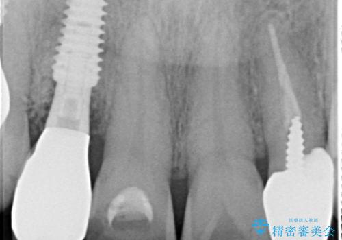 放置した破折歯 即時・早期のインプラント埋入による補綴治療の治療後