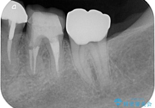 気になる奥歯のむし歯治療の治療後
