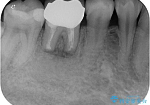 気になる奥歯のむし歯治療 歯根端切除術の治療後