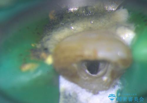 前歯の色が気になる!|他院で抜歯と言われた|歯を残したい|精密根管治療とオールセラミッククラウンで治療の治療中