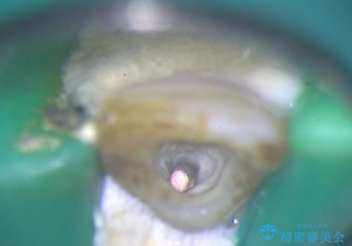 前歯の色が気になる!|他院で抜歯と言われた|歯を残したい|精密根管治療とオールセラミッククラウンで治療の治療中