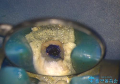 前歯の色が気になる!|他院で抜歯と言われた|歯を残したい|精密根管治療とオールセラミッククラウンで治療の治療中