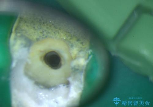 前歯の色が気になる!|他院で抜歯と言われた|歯を残したい|精密根管治療とオールセラミッククラウンで治療の治療中