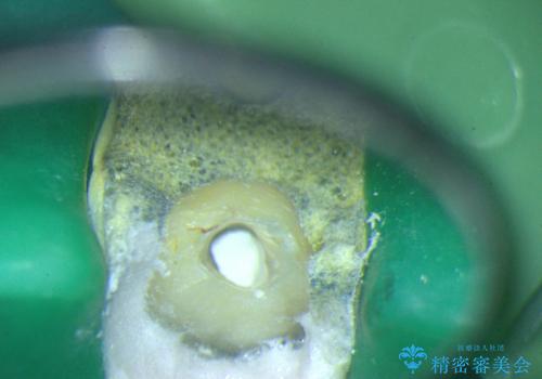 前歯の色が気になる!|他院で抜歯と言われた|歯を残したい|精密根管治療とオールセラミッククラウンで治療の治療中