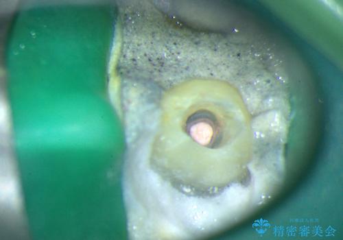 前歯の色が気になる!|他院で抜歯と言われた|歯を残したい|精密根管治療とオールセラミッククラウンで治療の治療中