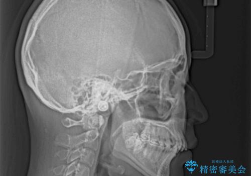 【モニター】デコボコと隠れてしまう前歯 ワイヤー装置による抜歯矯正で美しい口元にの治療前
